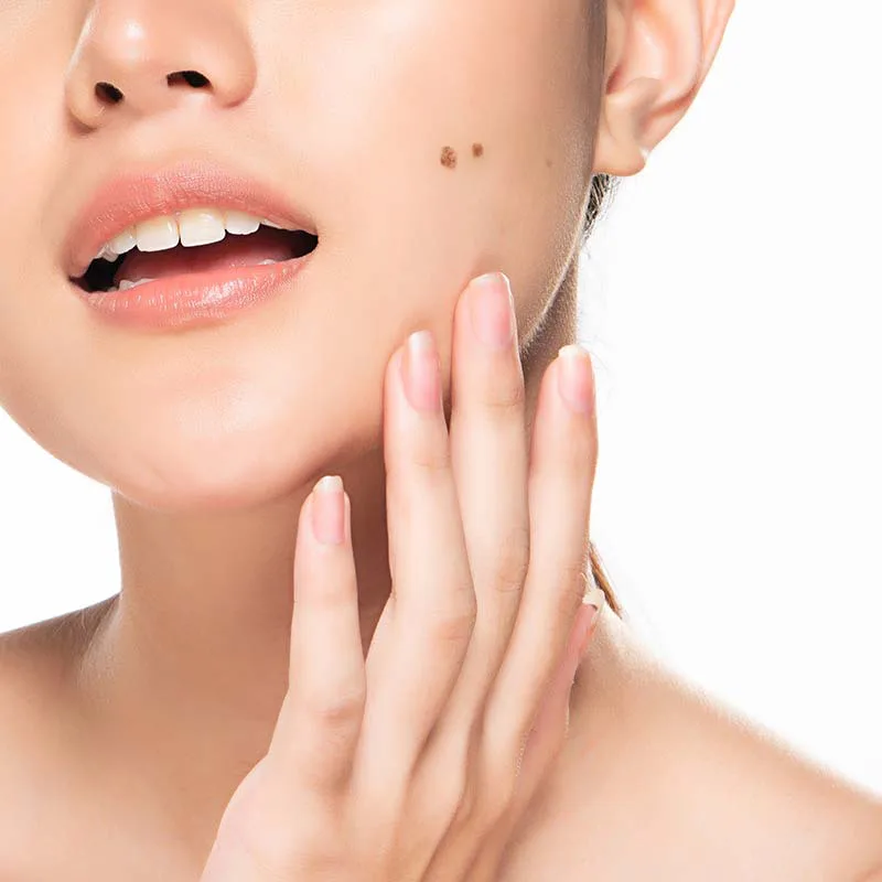 Trị nám da - Trước